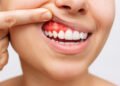 Understanding the Link Between Diabetes and Bleeding Gums