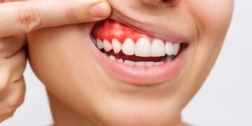Understanding the Link Between Diabetes and Bleeding Gums