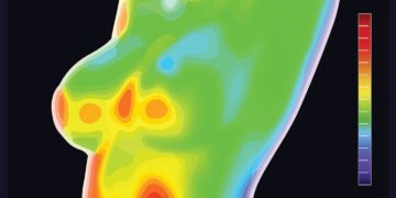 Breast Thermography: Technology, Benefits, and Cancer Signs