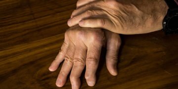 Uncovering the Causes of Psoriatic Arthritis: Identifying Triggers and Risk Contributors
